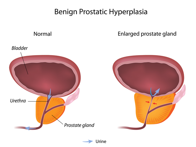 Understanding the symptoms of BPH: A comprehensive guide