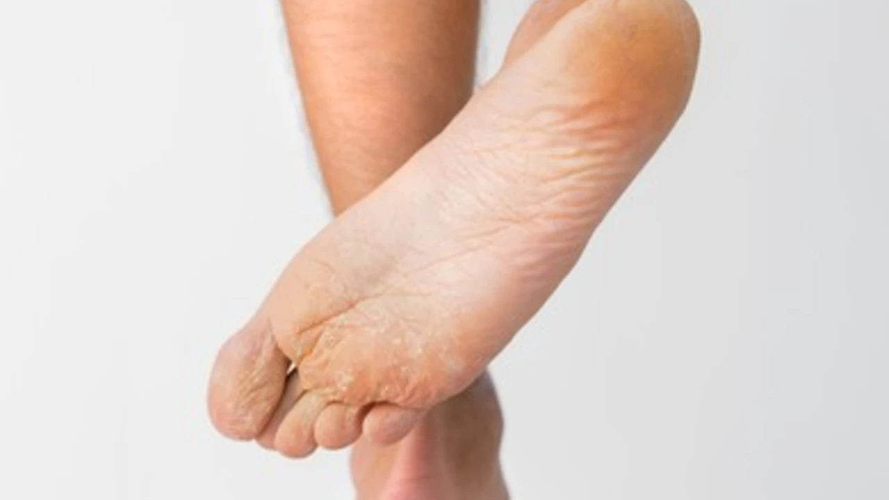 The Top 5 Athlete's Foot Myths Debunked